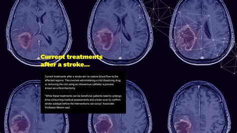 Life After Stroke The Discovery Set To Halt Brain Damage In Its Tracks