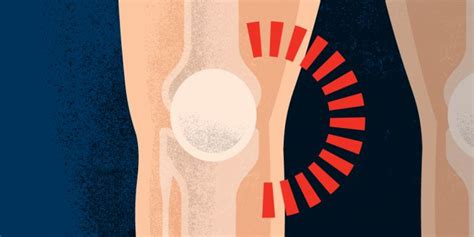 Inner Medial Knee Pain Health Information Bupa Uk