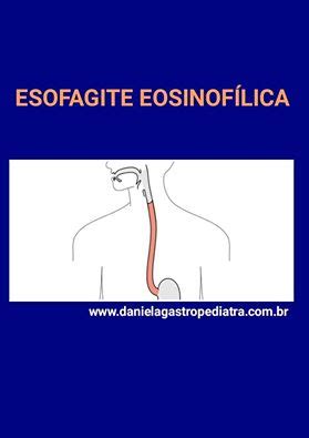 Dra Daniela Mendon A Gastropediatra Esofagite Eosinof Lica