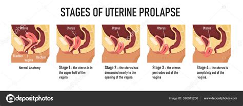 Estágios de prolapso uterino Ilustração vetorial Stock Vector by