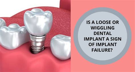 Is A Wiggling Dental Implant A Sign Of Implant Failure Denta Kings