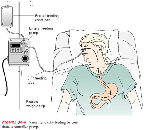 Nursing Process The Patient Receiving A Tube Feeding