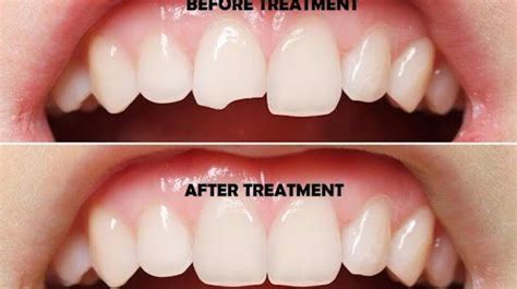 Tooth Reshaping All You Need To Know