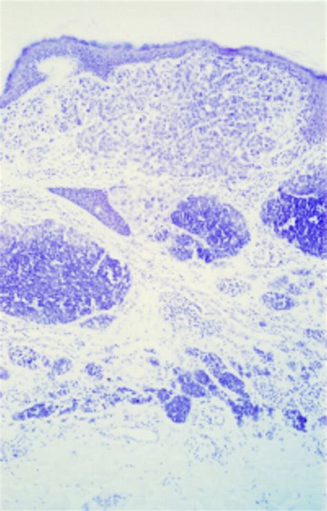 Small Cell Malignant Melanoma A Variant Of Naevoid Melanoma
