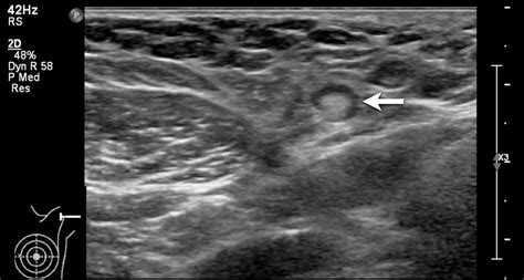 The Radiology Assistant Ultrasound Of The Breast