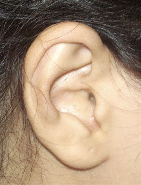 Pseudomonas Aeruginosa Infection Of The Auricular Cartilage Caused By