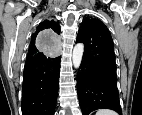 Ct Imaging Features Of Paravertebral Mediastinal Malignant Peripheral