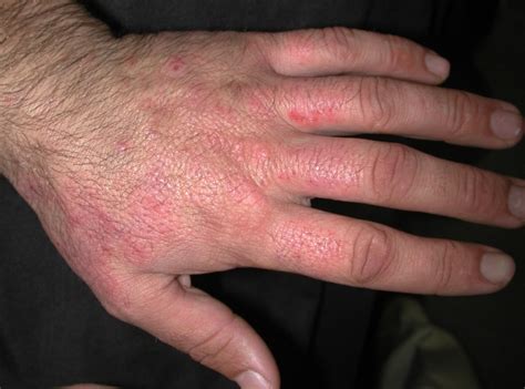 Acd A Z Of Skin Irritant Contact Dermatitis Icd