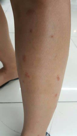 Is that new bump completely harmless—or something to worry. Red spots on my legs T-T - Picture of Space Inn Hengyang ...