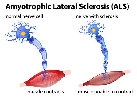 What is amyotrophic lateral sclerosis? ALS (Amyotrophic Lateral Sclerosis) | Brain Institute | OHSU