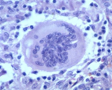 Giant Cells Giant Cells Multinucleated Multinucleated Giant Cells