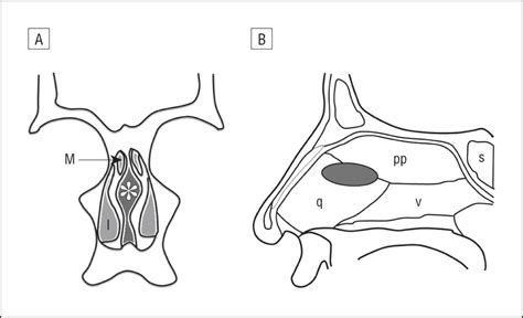 Radiographic And Anatomic Characterization Of The Nasal Septal Swell Body Otolaryngology