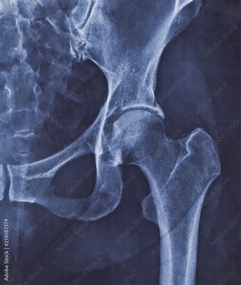 X Ray Image Of Hip Joint With Signs Of Coxarthrosis Stock Photo Adobe
