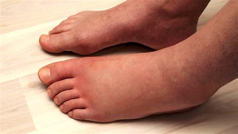 Scientists Explain Things That Cause Swollen Legs And How To Fix It