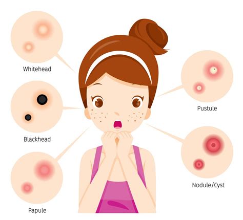 Learn The 4 Types Of Acne The Symptoms And How You Can Treat Them