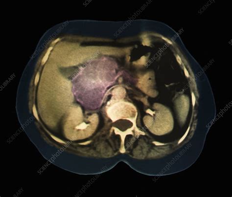 Cystic Pancreas Tumour Ct Scan Stock Image C0104894 Science