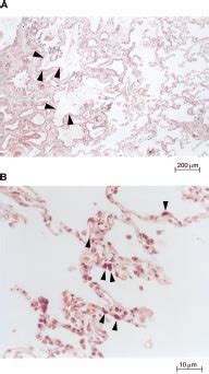 Table 1 lung parenchyma and emphysema parameters measured and derived using quantitative computed tomography. Lung parenchyma of patients with usual interstitial ...