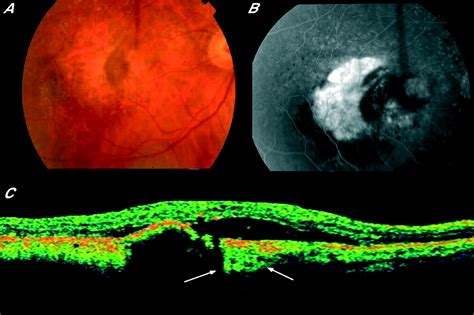 Retinal Pigment Epithelial Tear Following Intravitreal Bevacizumab For