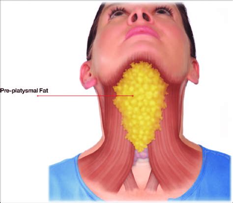 How To Dissolve Double Chin Fat Without Surgery Vci