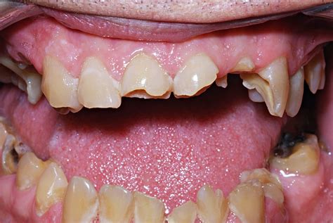 Cosmetic Bonding & Teeth Whitening | Zimmerman Dental Care