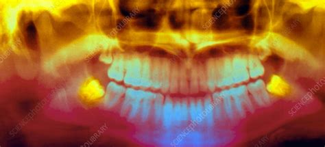 Coloured Pan Oral X Ray Of Impacted Wisdom Teeth Stock Image M782