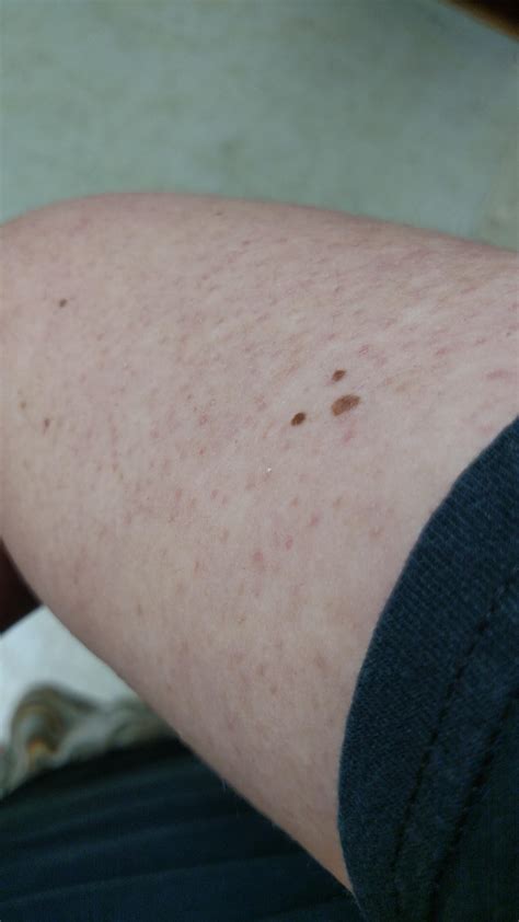 Could This Be From Picking Red Bumps All Over Upper Arms