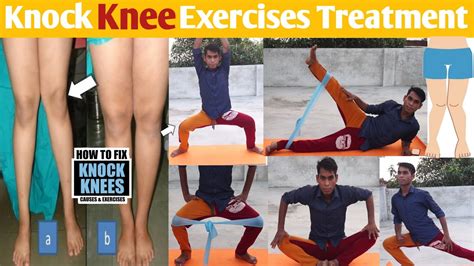 Knock Knees Correction Exercises Knock Knee Ko Kaise Thik Kare Genu