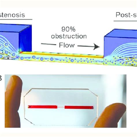 Microfluidic Studies Of Arterial Stenosis A Schematic Representation