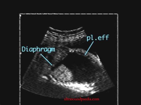 Pleural Effusion Ultrasoundpaedia
