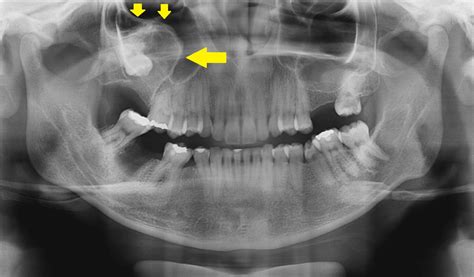 Os Seios Maxilares E Sua Relev Ncia Para O Cirurgi O Dentista Parte