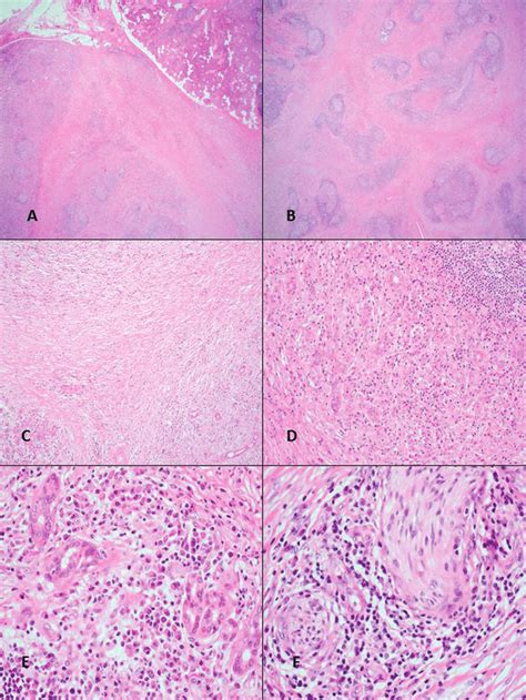 Characteristic Histological Features Of Chronic Sclerosing