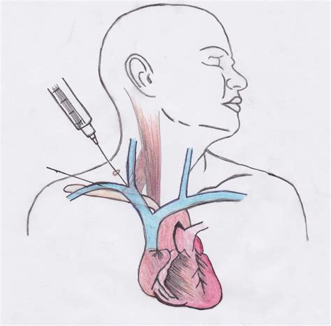 Subclavian Central Line Placement Landmarks