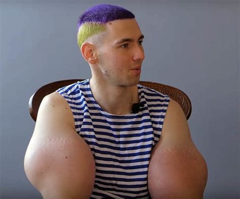 ‘freak Who Injected Homemade Potion Into Biceps Now Facing Amputation