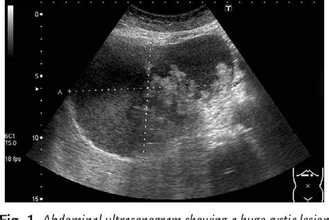 Figure 1 From Spontaneous Rupture Of A Simple Hepatic Cyst Complicated