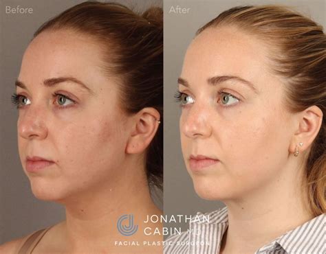 Face And Neck Procedures Before And Afters Dr Jonathan Cabin