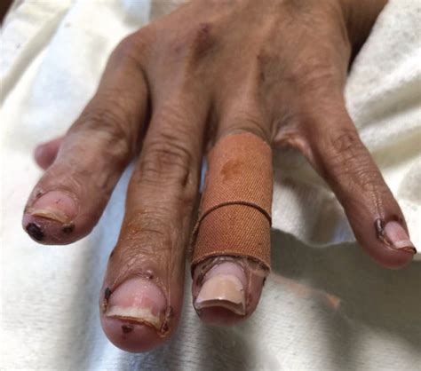 Small Hemorrhagic Vesicles On The Hands Of A Bullous Lupus Patient