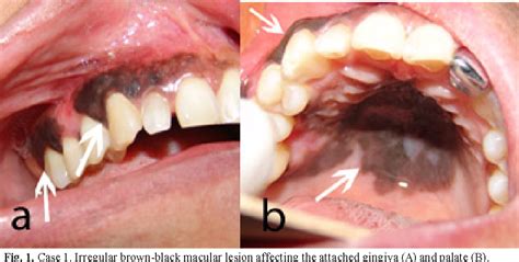 Figure 1 From Oral Mucosal Melanoma Conservative Treatment Including