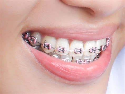 All You Need To Know About Dental Braces Hove Dental Clinic