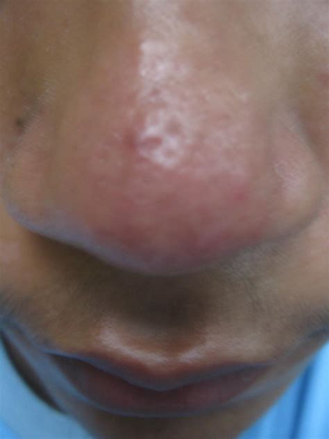 Hey How Can I Deal With This On My Nosewith Pics Scar Treatments