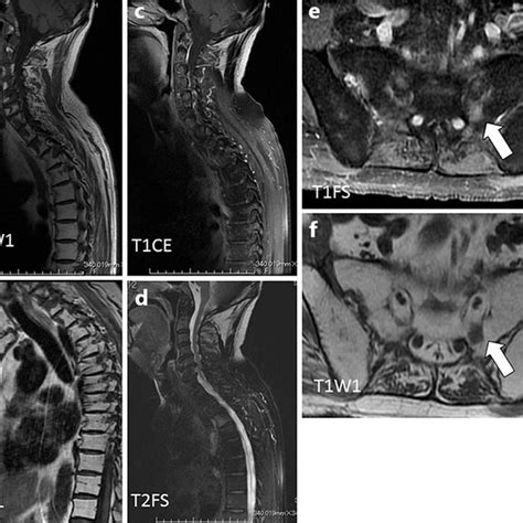 Sagittal T Weighted Mri Scans Of The Cervical Spine Vrogue Co