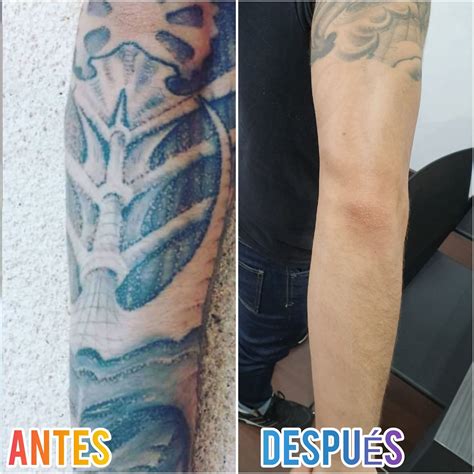 Arriba Foto Eliminacion De Tatuajes Antes Y Despues El Ltimo