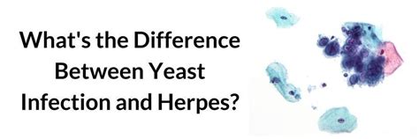 What S The Difference Between Yeast Infection And Herpes Beat Candida