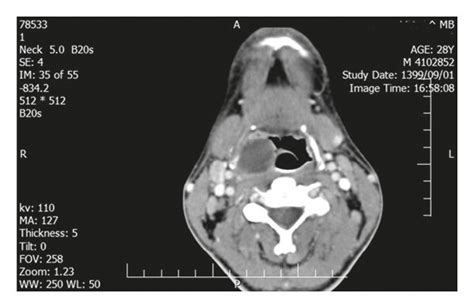 Head And Neck Ct Scan With Iv Contrast Shows Right Peritonsillar