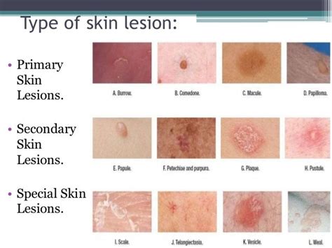 10 Types Of Skin Lesions