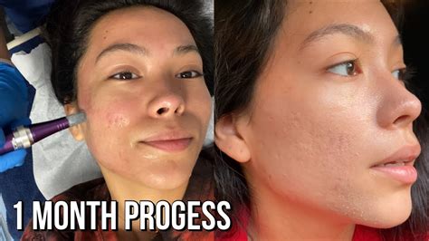 Best Way To Remove Acne Scars Microneedling Session 2 Youtube