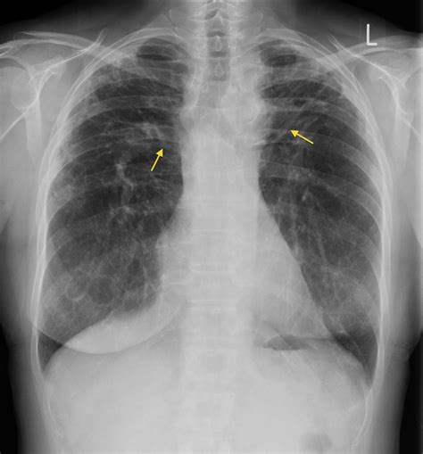 Sarcoidosis Interstitial Lung Disease Captions Trending Update