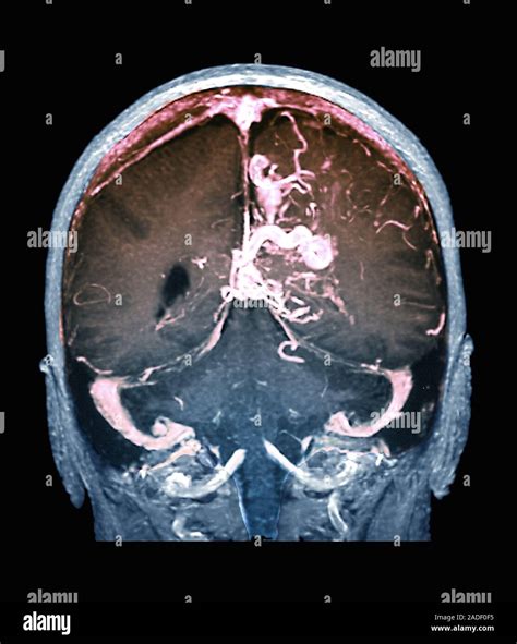 Cerebral Arteriovenous Malformation Coloured Magnetic Resonance