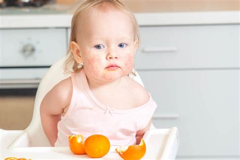 Alergia alimentar no bebê sintomas causas e o que fazer Tua Saúde