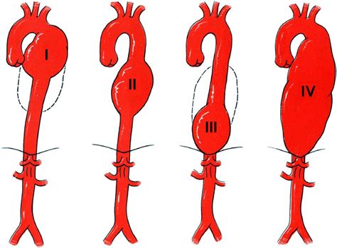 Nuestros expertos han respondido 3 preguntas sobre aneurisma de la aorta torácica. Aneurisma de la aorta: ¿qué es? Síntomas, operación y más
