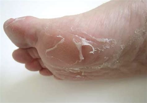 Children who suffer from the skin disorder called psoriasis can often go undiagnosed. Skin Peeling on Feet - Symptoms, Causes, Treatment, Remedies